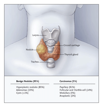 thyroid nodules removal